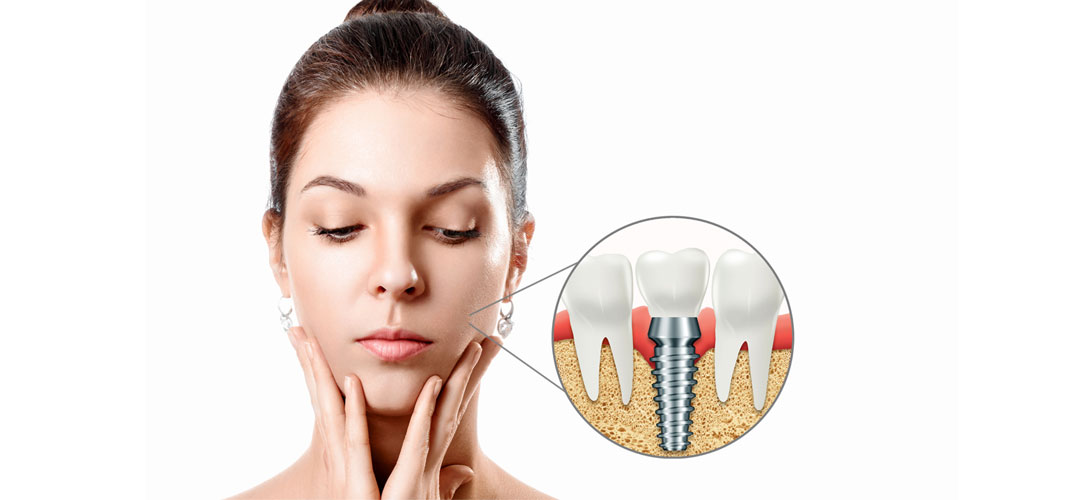 Dental Implants in Chennai