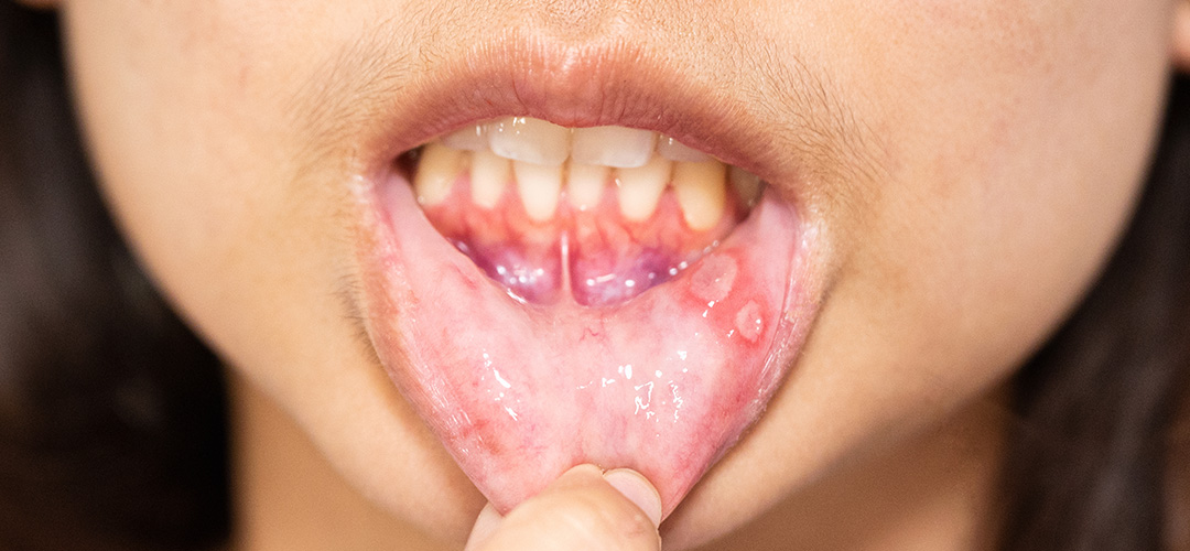 Mouth-Ulcer-Treatment-in-chennai