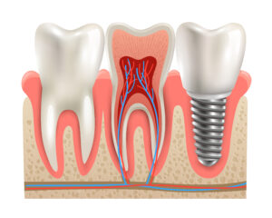 Dental Implants in Chennai 